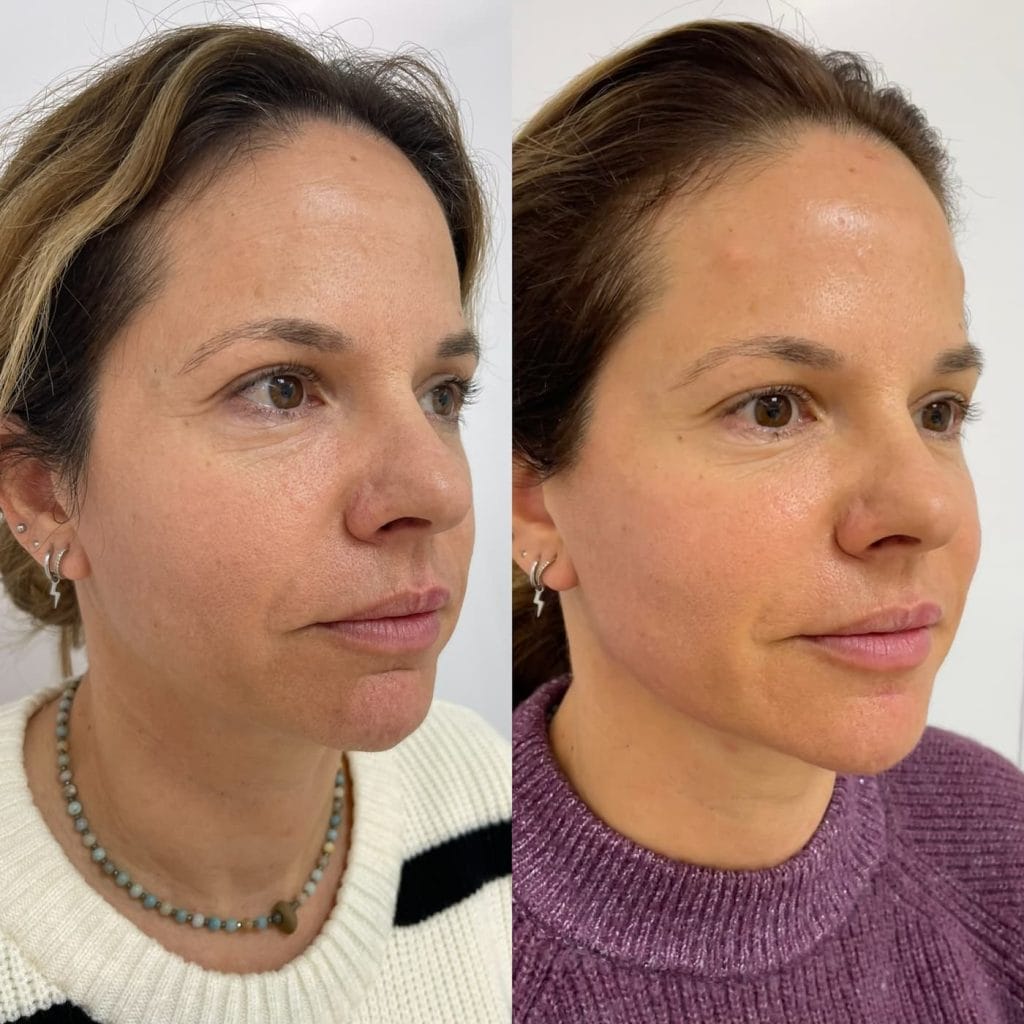 Antes y despues de armonizacion facial full face en tres cuartos derecho con mejoria de contorno y perfilado en Clinica Eterea Valencia
