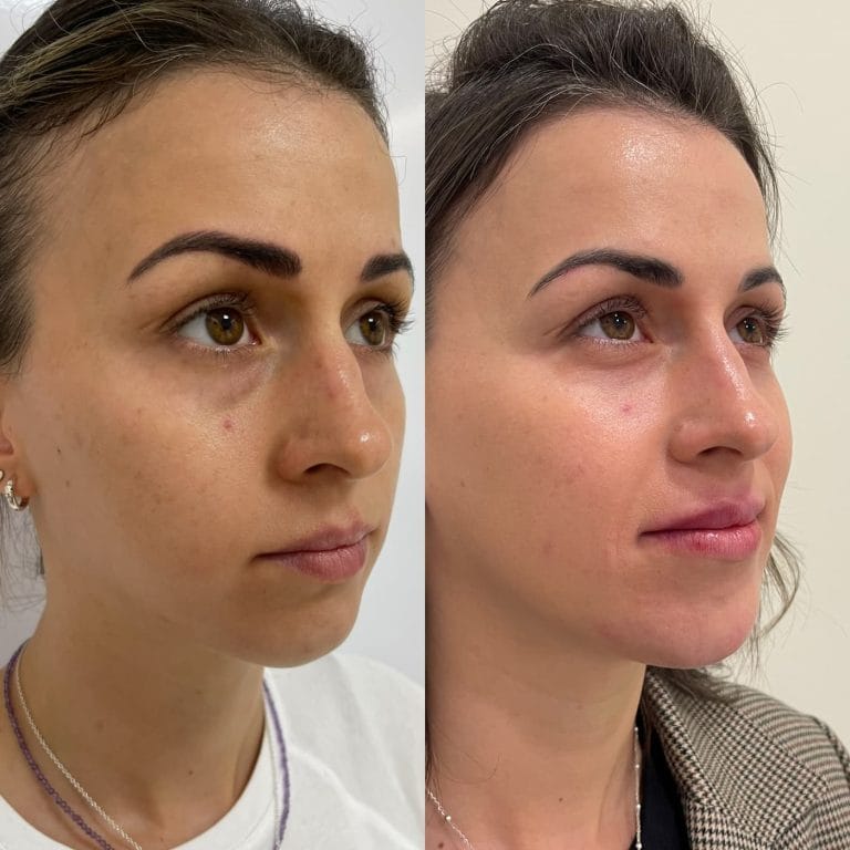 Antes y despues de armonizacion facial full face con acido hialuronico y neuromoduladores en Clinica Eterea Valencia