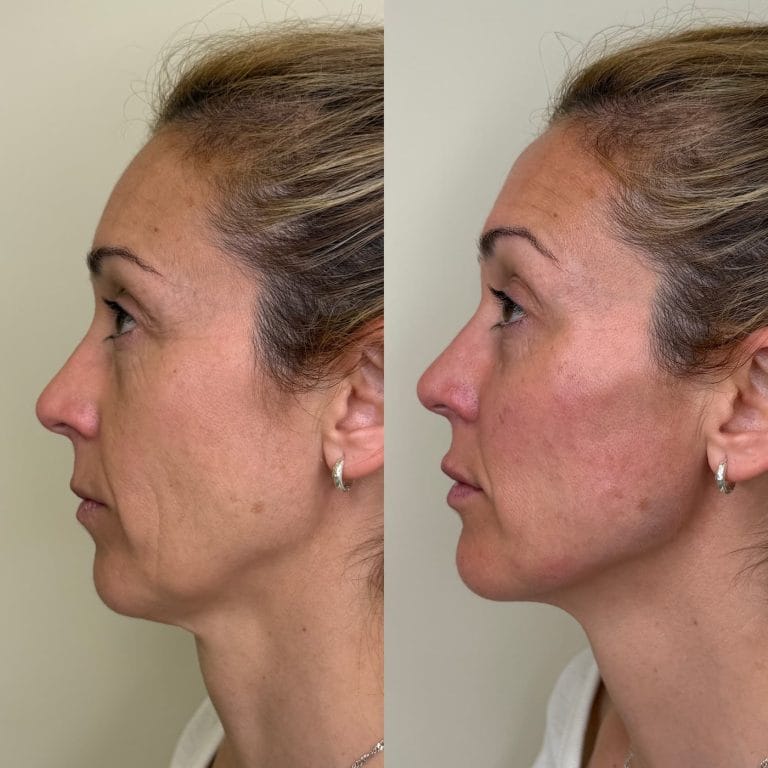 Antes y despues armonizacion facial full face en perfil lateral con mejora de proyeccion menton y linea mandibular en Clinica Eterea Valencia