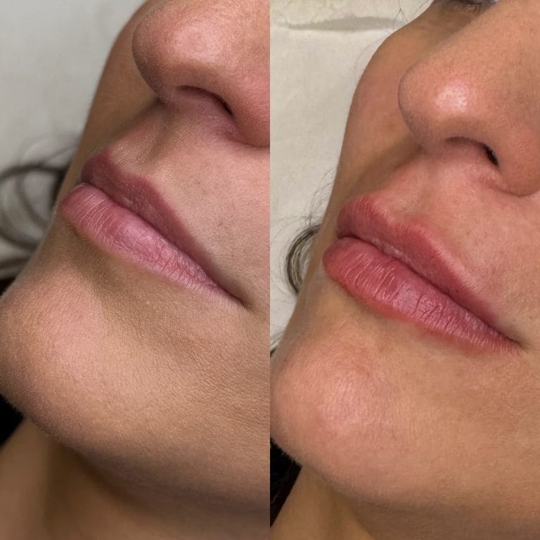 Labios con ácido hialurónico en Valencia: Resultado natural de aumento de volumen y definición de arco de cupido.