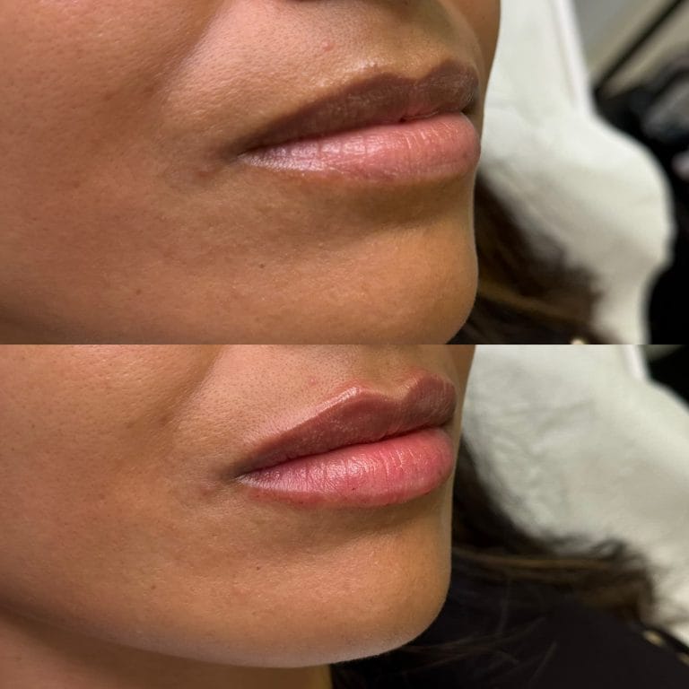 Labios con ácido hialurónico antes y después: Aumento de volumen y definición en ángulo lateral en Valencia.