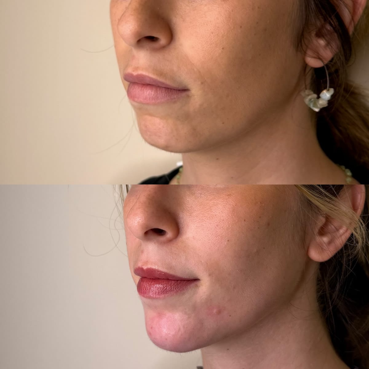 Antes y después del tratamiento de mentón con ácido hialurónico: Proyección del mentón y mejora del perfil facial en Valencia.