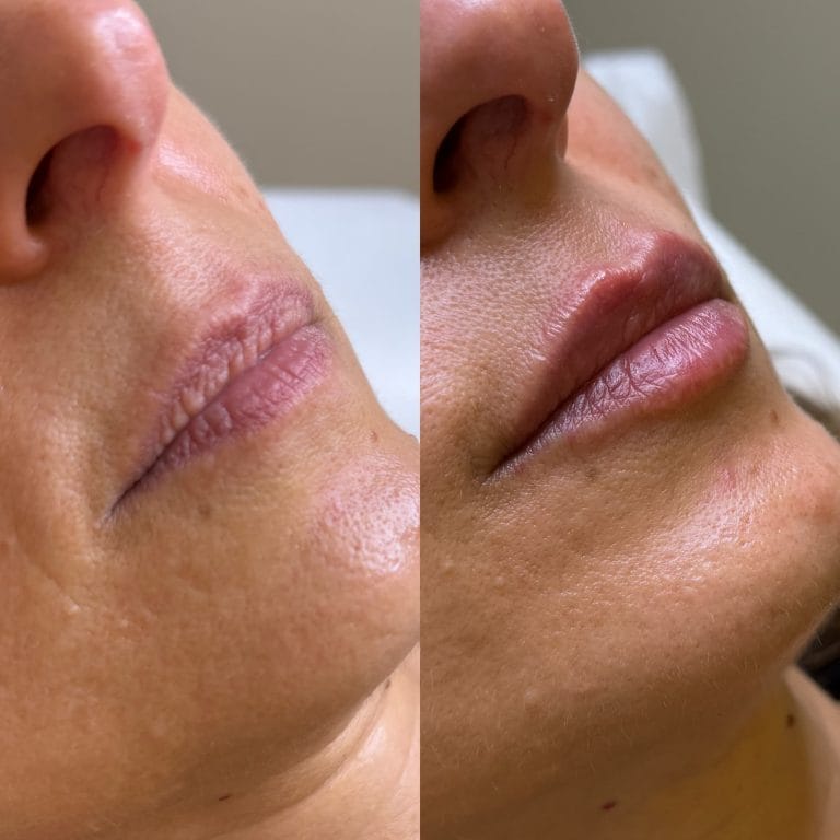 Corrección de labios secos y agrietados con ácido hialurónico para hidratación profunda en Valencia.