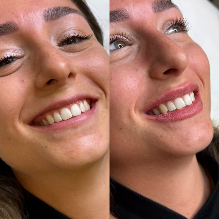 Antes y después del Tratamiento de sonrisa gingival