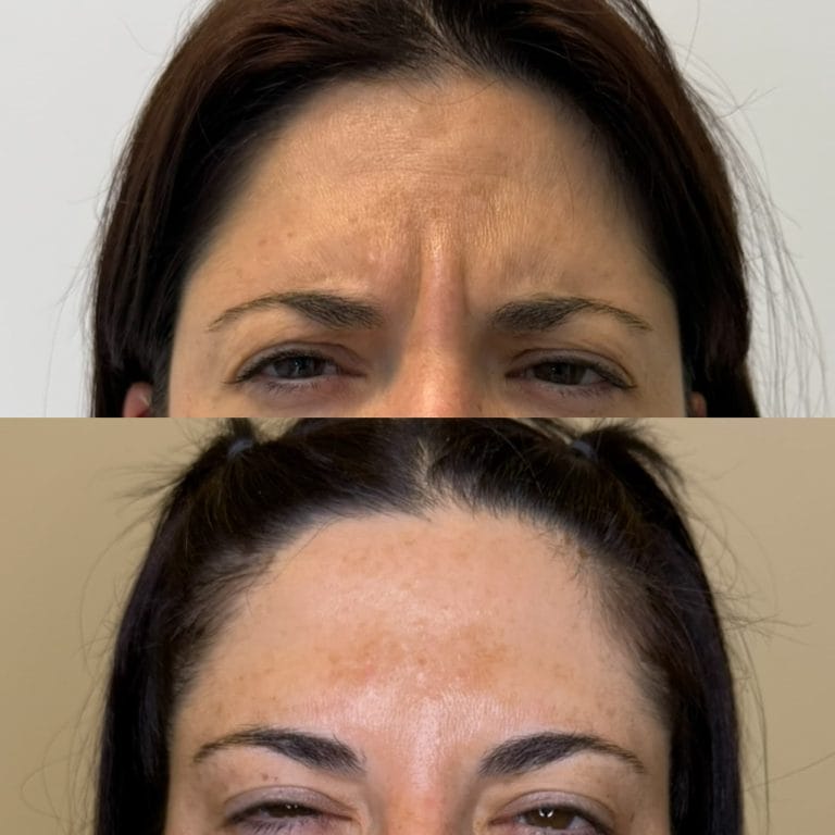 Efecto suavizado tras aplicación de neuromoduladores en el tercio superior