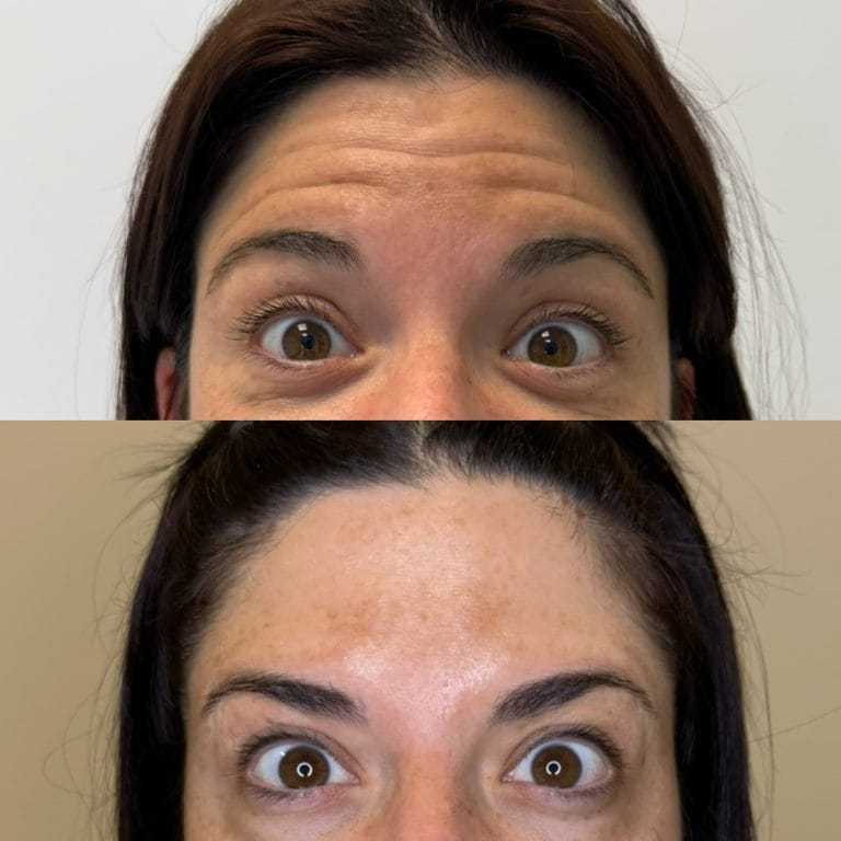 Resultado natural de neuromoduladores en el tercio superior en Valencia