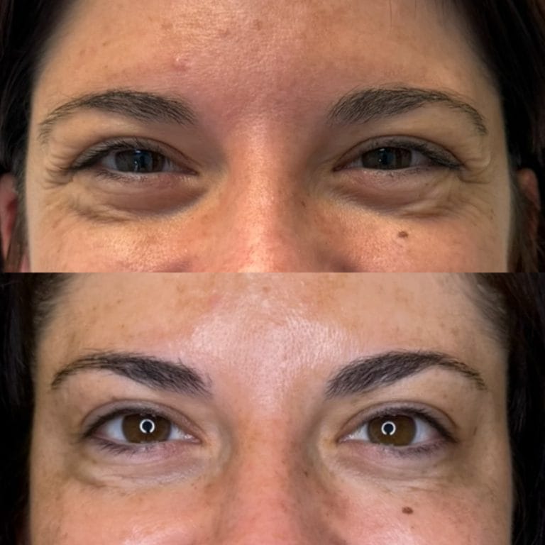 Paciente de Clínica Etérea antes y después de recibir tratamiento con neuromoduladores en patas de gallo en Valencia.