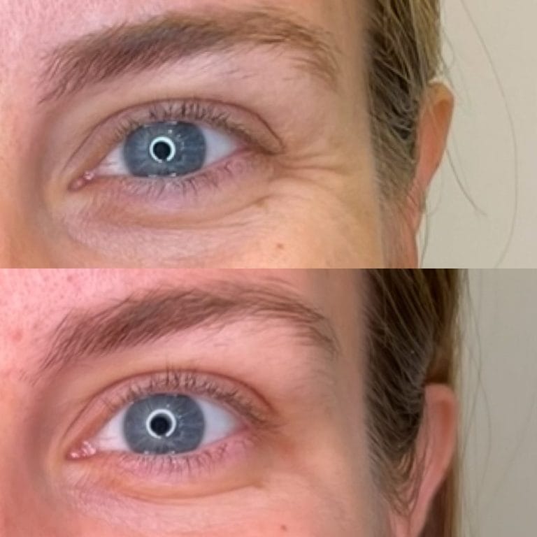 Resultado real de antes y después del tratamiento con neuromoduladores en patas de gallo realizado en Clínica Etérea.