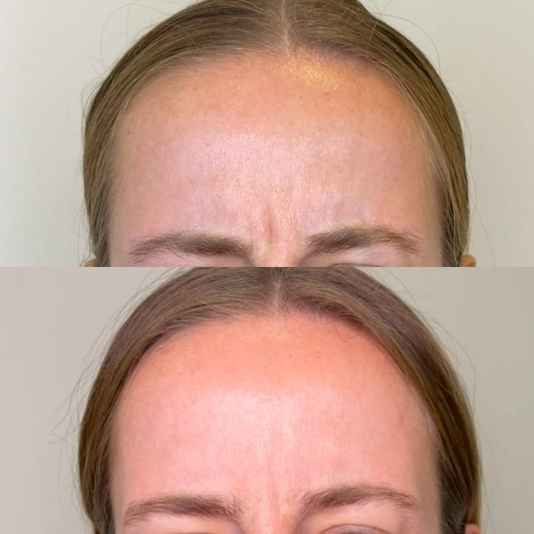 Corrección de arrugas con neuromoduladores en el tercio superior