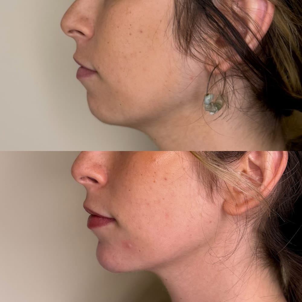 Perfilado del mentón con ácido hialurónico: Mayor proyección y definición de la mandíbula en Valencia.