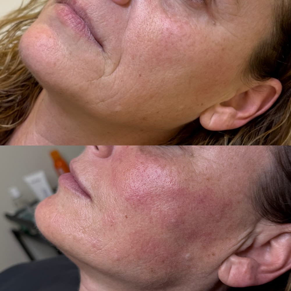 Redensificación y mejora de la calidad de la piel con Volite: Antes y después del tratamiento facial en Valencia.