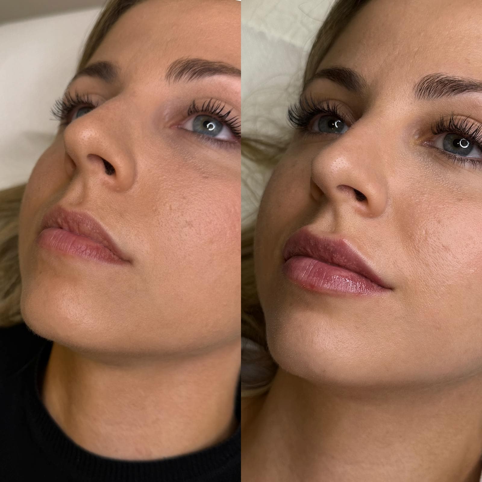 Rejuvenecimiento de labios con ácido hialurónico para paciente joven en Clínica Estética Valencia.