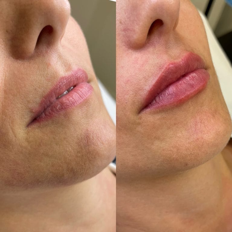 Perfilado y relleno de labios con ácido hialurónico en Clínica Estética Valencia: Antes y después.