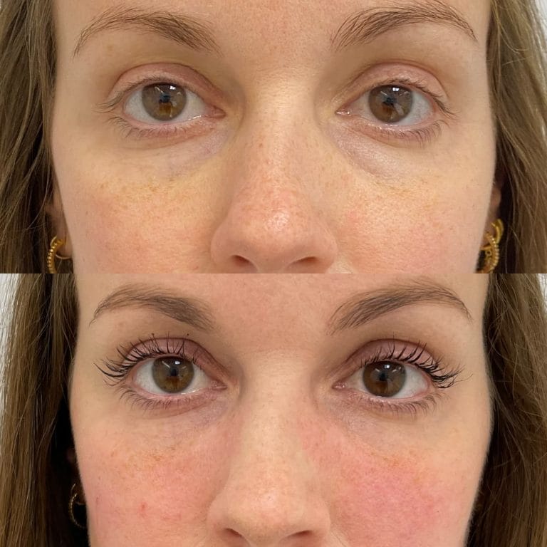 Tratamiento de ojeras con ácido hialurónico en perfil: Corrección de la depresión del valle lagrimal en clínica estética Valencia.