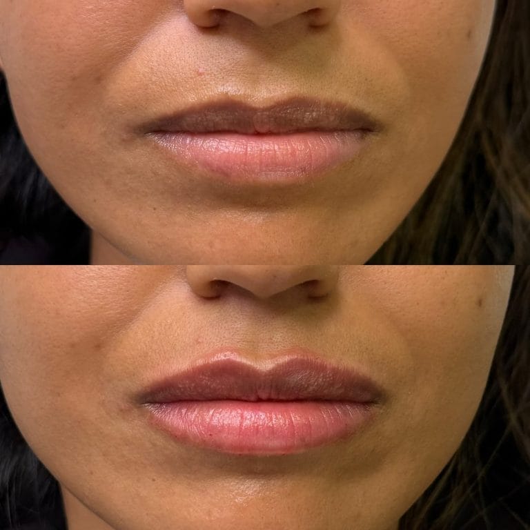 Labios con ácido hialurónico: Resultado frontal de aumento de volumen y corrección de asimetría en Valencia.