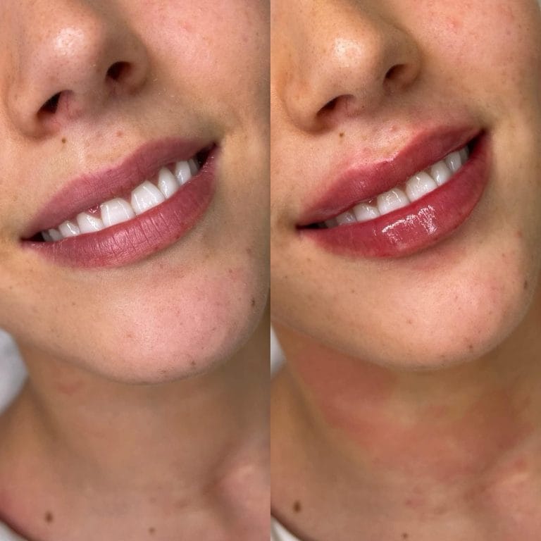 Labios con ácido hialurónico y sonrisa radiante en Valencia. Antes y después con brillo labial.