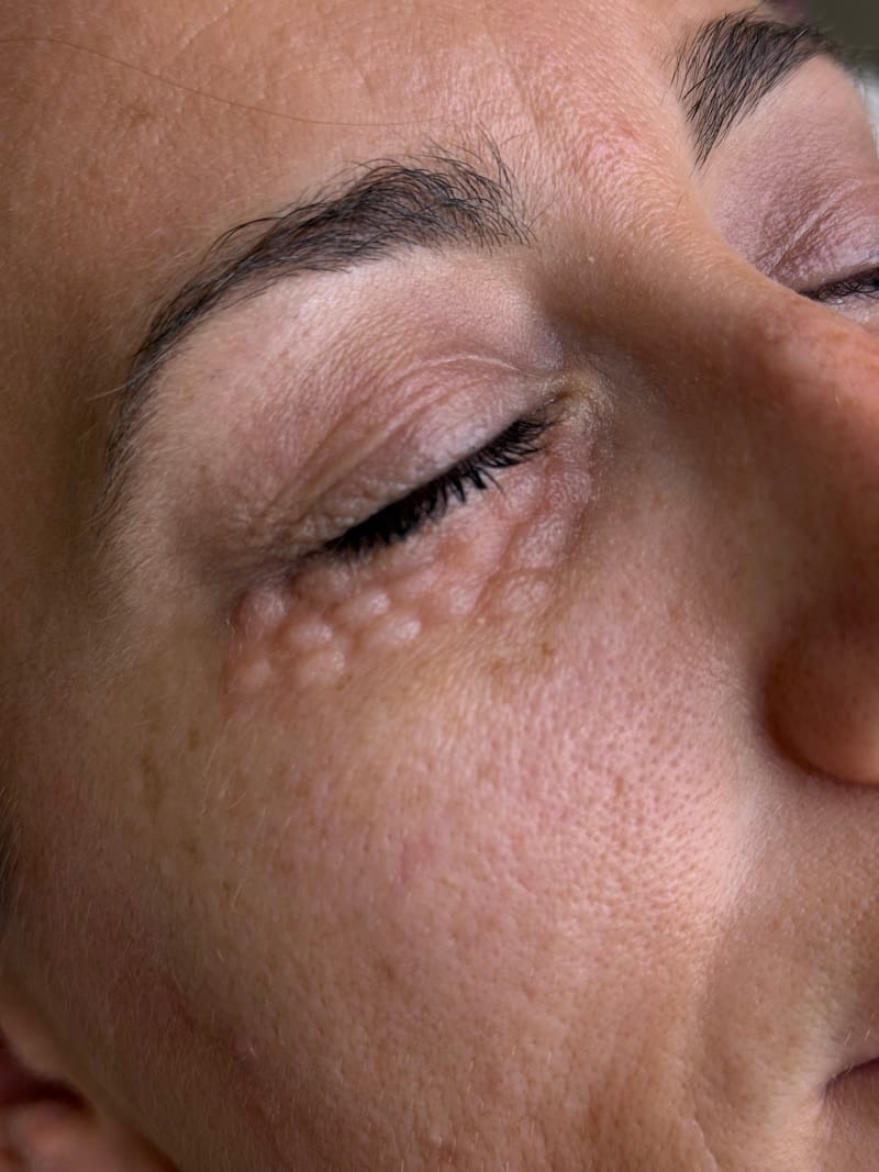 Piel del contorno de ojos tras la inyección de vitaminas y ácido hialurónico para revitalización e hidratación profunda en Valencia.