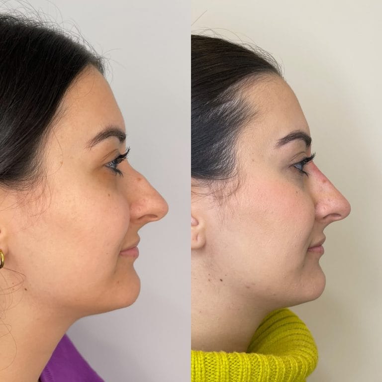 Rinoplastia sin cirugía con ácido hialurónico en Valencia: Resultado natural y sutil en el perfil derecho.