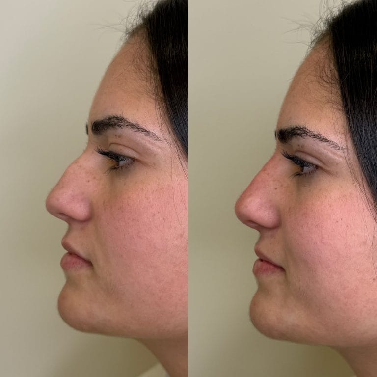 Rinomodelación con ácido hialurónico antes y después: Corrección de giba nasal y elevación de punta en Valencia.