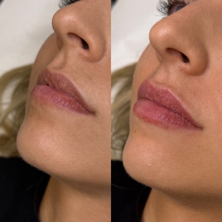 Aumento de labios sutil y natural con ácido hialurónico en Valencia. Resultado lateral.