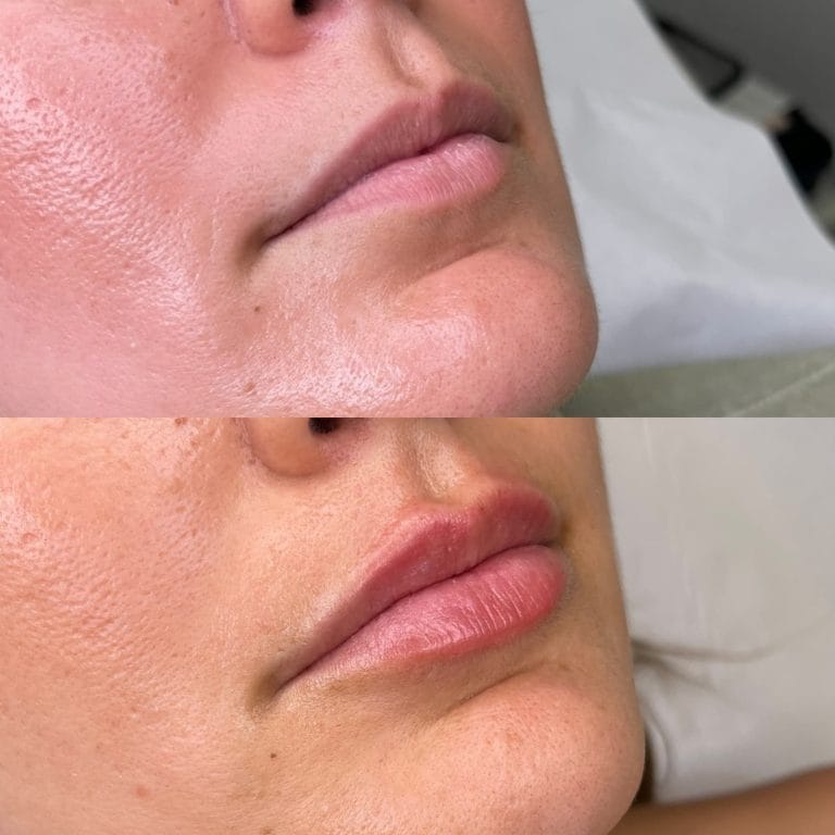 Antes y después de labios con ácido hialurónico. Técnica para un aumento natural y discreto en Clínica Etérea.