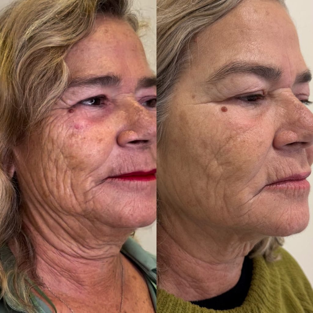 Antes y después del tratamiento de inductores de colágeno para flacidez facial y arrugas profundas en Valencia.