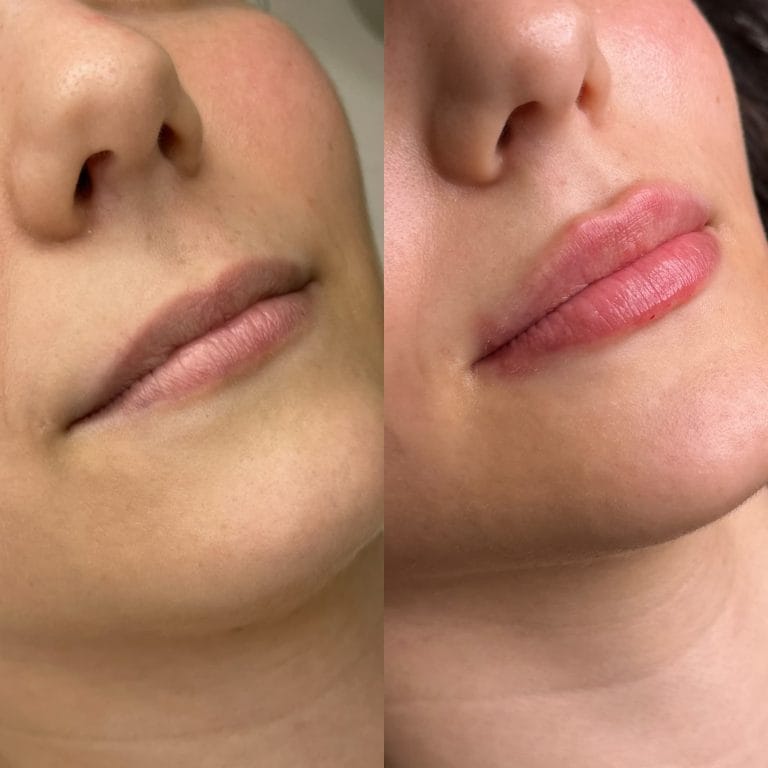 Labios antes y después de tratamiento con ácido hialurónico: Mejora de contorno y corrección de asimetría labial en Valencia.