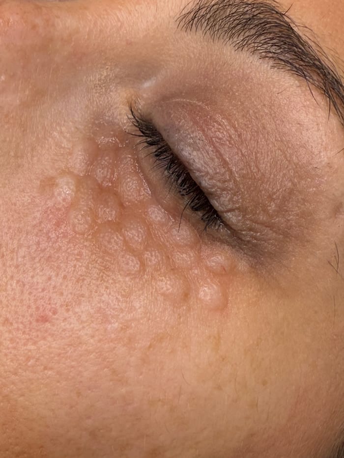 Aplicación del tratamiento de vitaminas perioculares en Valencia: Infiltración de complejo revitalizante en contorno de ojos.