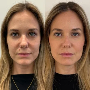 Antes y despues de tratamiento de armonizacion facial full face en Valencia Clinica Eterea