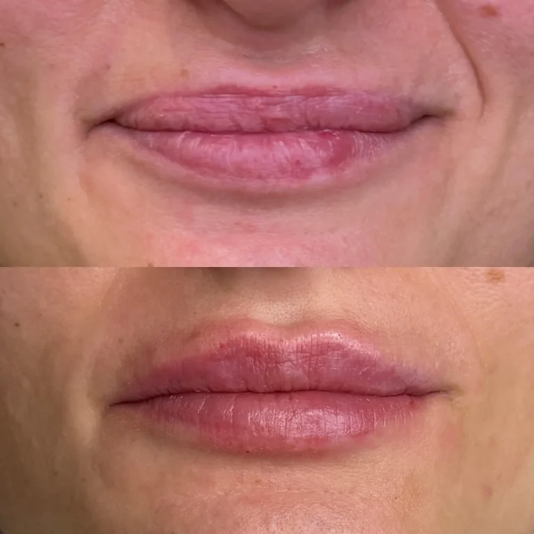 Antes y despues aumento de labios con acido hialuronico en Valencia Clinica Eterea