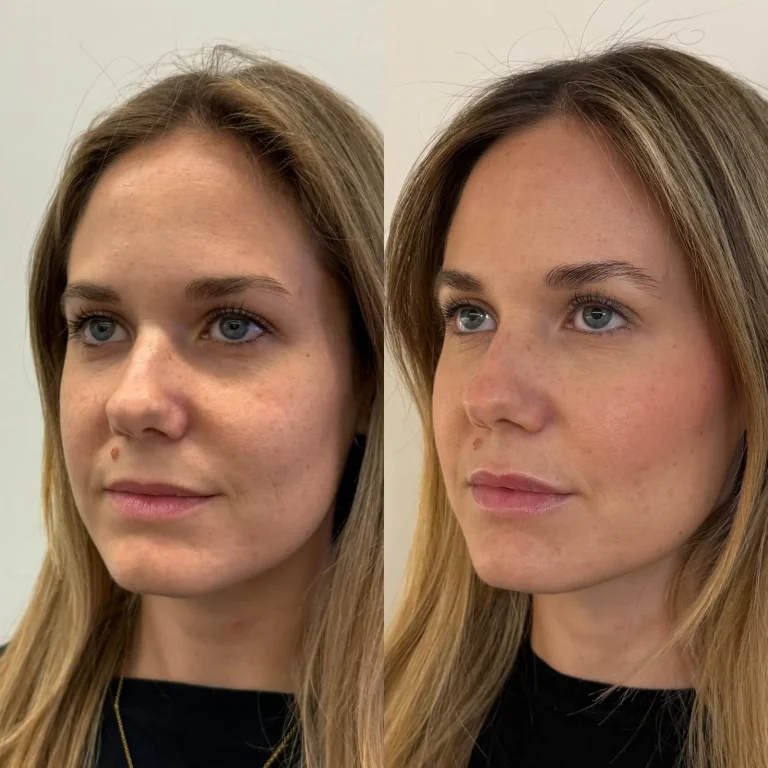 Armonizacion facial full face y labios en Valencia Clinica Eterea