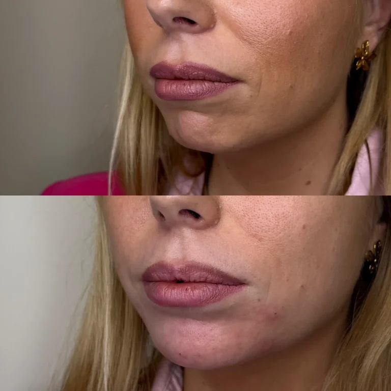 Antes y despues aumento de menton con acido hialuronico en Valencia Clinica Eterea