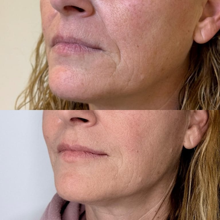 Antes y después de tratamiento con inductores de colágeno e hidratación profunda de labios en Clínica Etérea Valencia