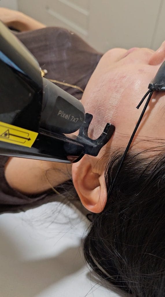 Aplicación de láser ablativo facial en Clínica Etérea Valencia