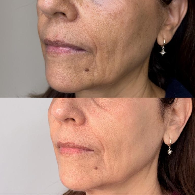 Resultado antes y después de tratamiento con láser IPL facial en Clínica Etérea Valencia