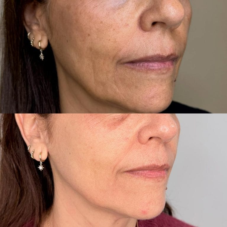 Mejora del tono y textura de la piel tras láser IPL en Clínica Etérea Valencia