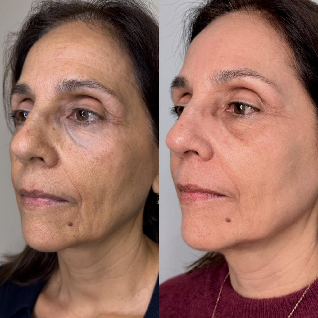 Antes y después de tratamiento con láser IPL para manchas y tono de la piel en Clínica Etérea Valencia