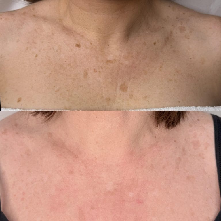 Tratamiento de luz pulsada IPL durante sesión en Clínica Etérea Valencia