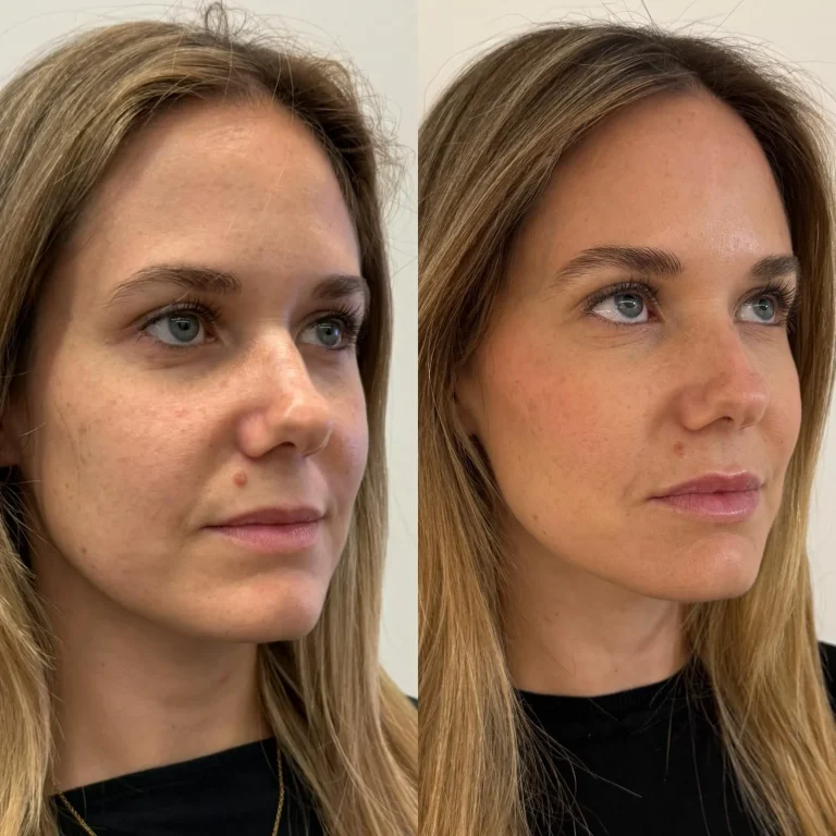 Rejuvenecimiento facial integral full face antes y despues en Valencia Clinica Eterea