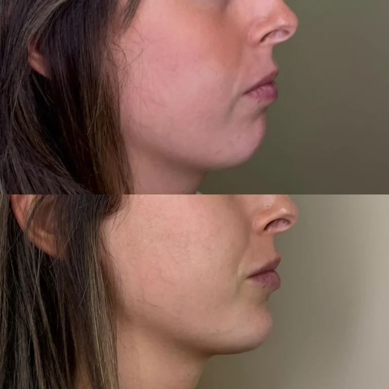 Perfil antes y despues relleno de labios y menton en Valencia Clinica Eterea