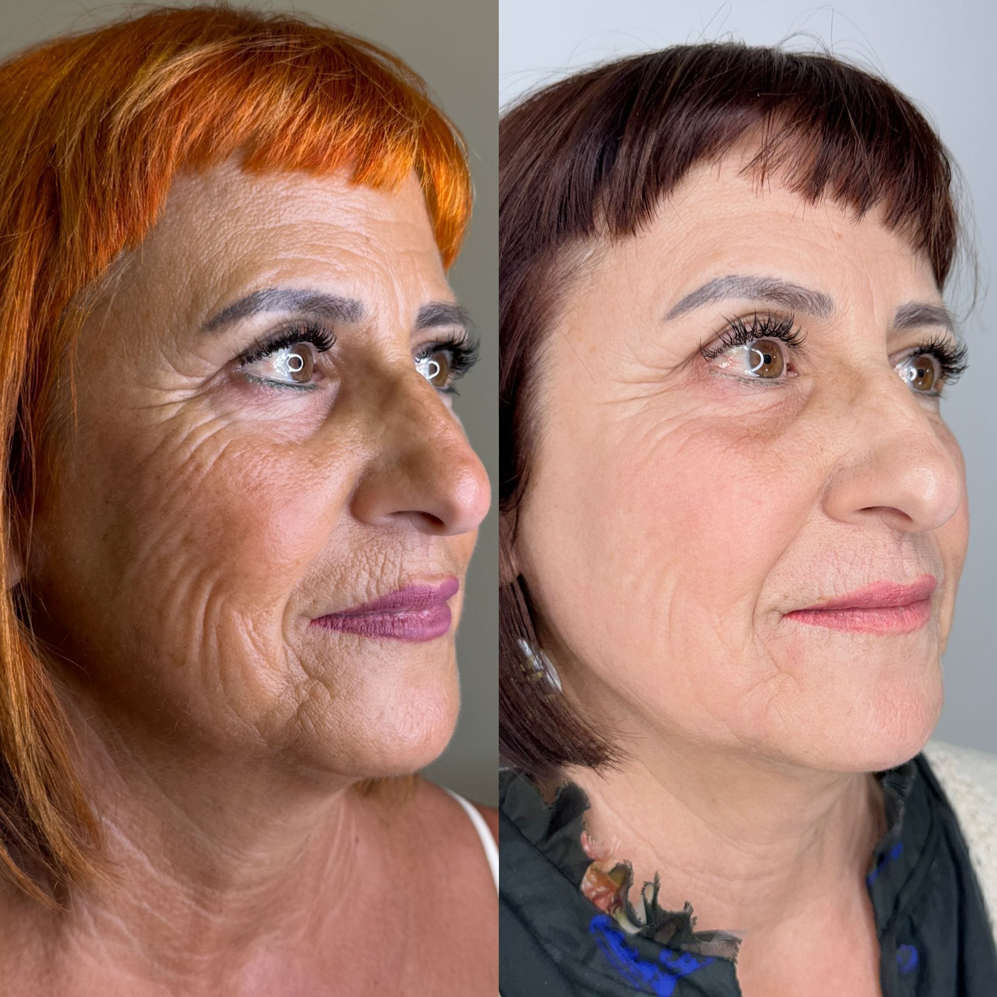 Antes y después de la eliminación de arrugas con láser ablativo en Clínica Etérea Valencia