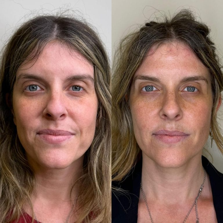 Comparativa antes y después de tratamiento combinado de inductores de colágeno y neuromoduladores en Clínica Etérea Valencia.