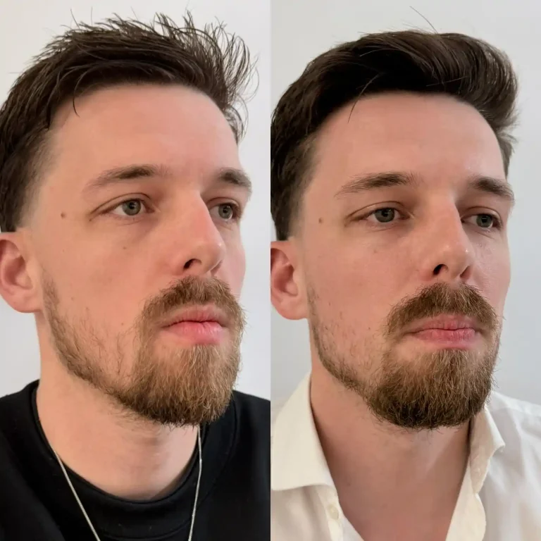Comparativa oblicua de tratamiento Full Face masculino enfocado en angulación y definición de rasgos. Cambio radical antes y después de masculinización facial full face en hombre joven.