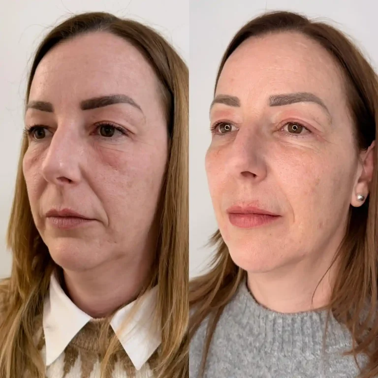 Caso clínico de paciente tratada con protocolo Full Face Armonización Facial para combatir signos de edad. Comparativa antes y después de tratamiento de rejuvenecimiento facial integral sin cirugía en Valencia.