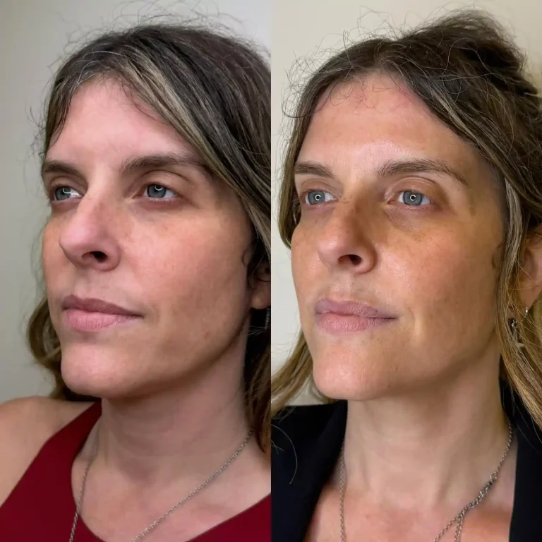 Armonización Facial Full Face. Vista oblicua detallando la mejora en la zona periocular y tercio medio. Tratamiento de corrección de ojeras y soporte de pómulos sin cirugía en Clínica Etérea.