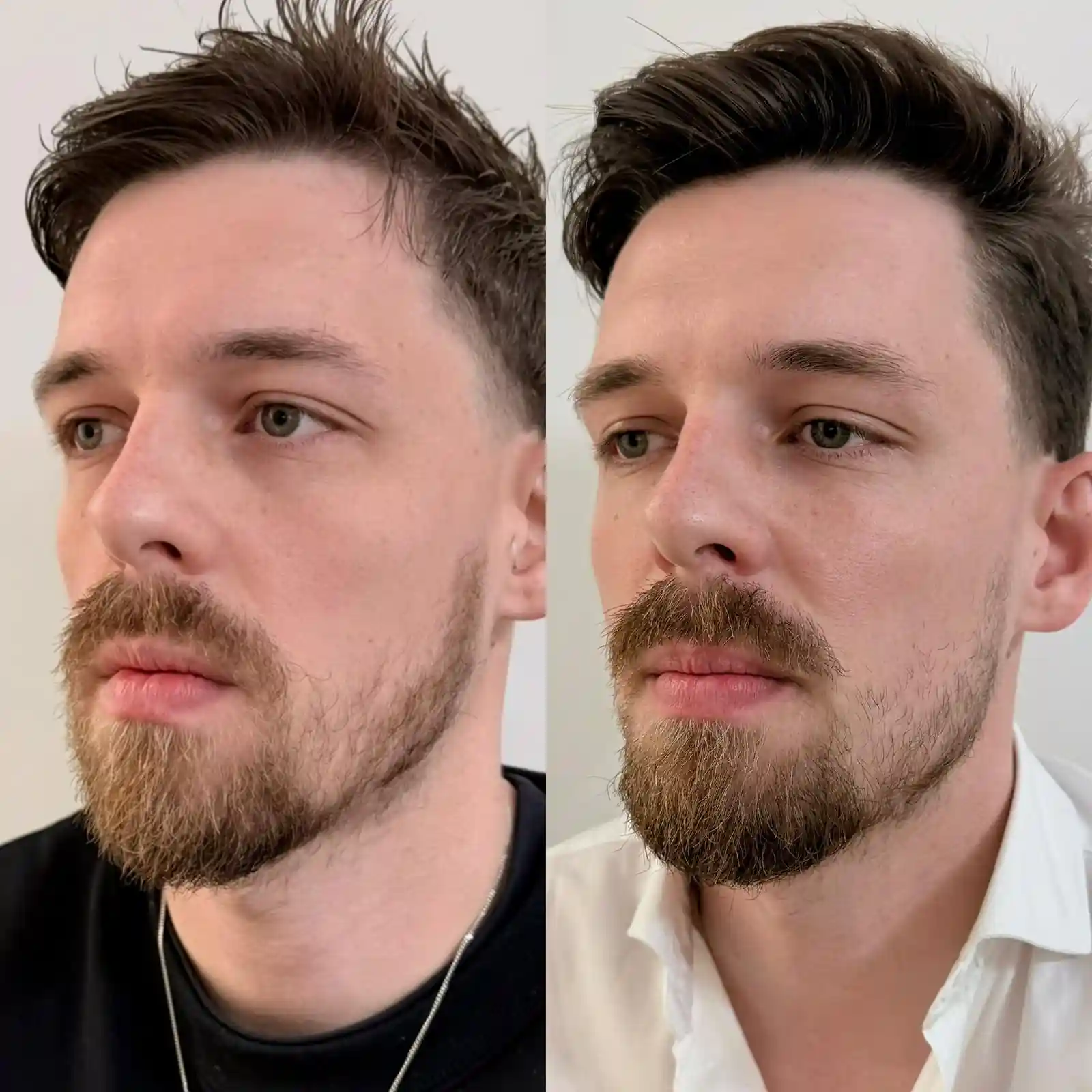 Tratamiento completo de marcación mandibular con ácido hialurónico realizado en Valencia. En esta vista de detalle se aprecia cómo la técnica de infiltración profunda crea una separación visual limpia entre el rostro y el cuello corrigiendo la flacidez y aportando esa estructura cuadrada y atlética típica del canon de belleza masculino. Detalle lateral de tratamiento de marcación mandibular en hombre para definir el arco y proyectar el mentón en Clínica Etérea Valencia.