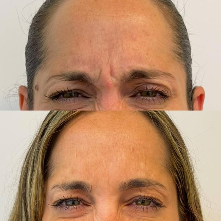 Comparativa antes y despues de un rejuvenecimiento del tercio superior con neuromoduladores en Clinica Eterea.