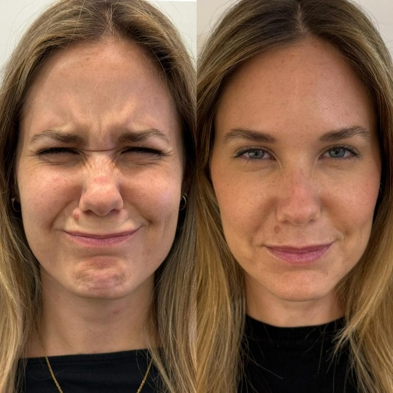 Detalle de los resultados del tratamiento de bunny lines o arrugas en la nariz en Clinica Eterea Valencia.