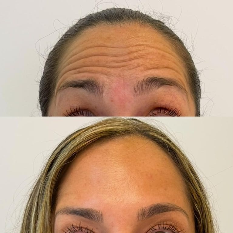 Primer plano que muestra una frente lisa y rejuvenecida tras aplicar neuromoduladores en Clinica Eterea Valencia.