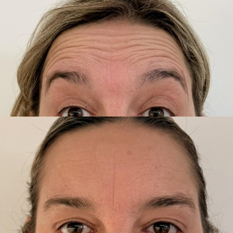 Imagen de los resultados obtenidos tras el tratamiento combinado de frente y entrecejo en Valencia.